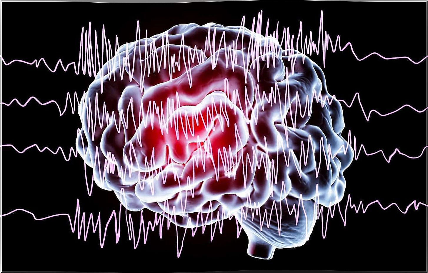 brain with dyskinesia